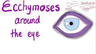 Ecchymoses around the eye [upl. by Franklyn]