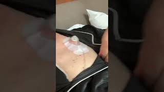 Chemo 46hour Fluorouacil drip infused at home after inhospital Folfirinox infusion [upl. by Suivat458]