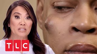 Riesenknubbel im Gesicht  Dr Pimple Popper  TLC Deutschland [upl. by Eiral]