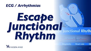 ECG 54  Escape Junctional Rhythm [upl. by Kred413]