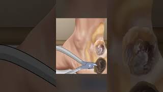 Remove Large Plantar Warts Calluses asmr shrots animation [upl. by Euell544]