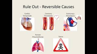 ACLS 2020 Algorithm Shockable Arrest [upl. by Nibroc]