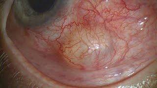 Cyst over Paul Glaucoma Implant 3 Months after Surgery [upl. by Boony]