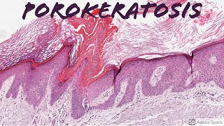 Porokeratosis 5Minute Pathology Pearls [upl. by Erodavlas]