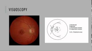 Visuoscopy Fixation Ophthalmoscopy [upl. by Nodnek]