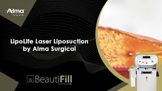 LipoLife Laser Liposuction by Alma Surgical [upl. by Aihseit]