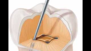 Sistema de ultrasonido para endodoncia [upl. by Anilrats29]