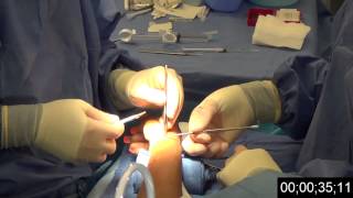 DeQuervains Procedure with timer [upl. by Thatcher]