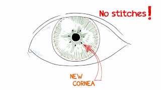 What is a Cornea Transplant [upl. by Marchal413]