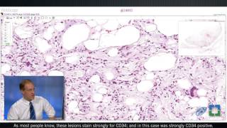 Pathology Insights WellDifferentiated Lipomatous Tumors with John Goldblum MD [upl. by Thor]