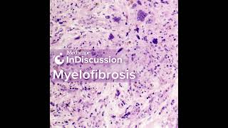 Whats Your Approach Treating Myelofibrosis [upl. by Murray]