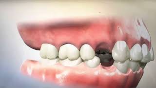 Removing Teeth for Braces  Why Extracting and Retracting Orthodontics is harmful [upl. by Attaymik]