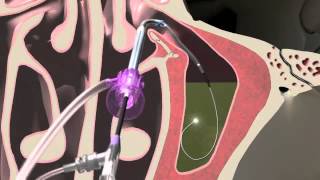 Balloon Sinuplasty Animation of the Maxillary Sinus  Seattle Sinus Surgeon [upl. by Flowers194]