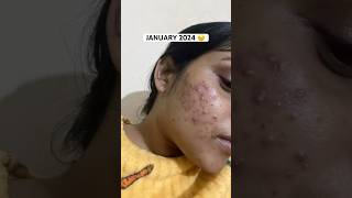 How I cleared my Acne  Acne journey  Get rid of acne  Adult Acne  Products that helped me [upl. by Eirrak460]