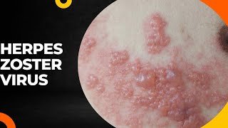 TOPICquot24HERPES ZOSTER VIRUSamp ITS CAUSES SYMPTOMS DIAGNOSIS AND TREATMENT [upl. by Kumler]