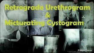 RGU MCU Retrograde Urethrogram and Micturating Cystogram Case Interpretation [upl. by Cherianne]