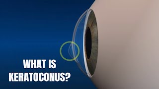 Keratoconus Symptoms and Treatment options [upl. by Layor]