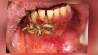 Oral maggots worms in the mouth  oral myiasis  treatment [upl. by Nagam]