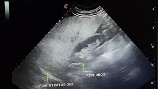 Échographie abdominale Stéatose hépatique diffuse Hepatomegalie FH a 215 mm [upl. by Rivers]