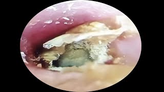 Fungous dry orange earwax extraction asmrearwax 20 [upl. by Aiht]