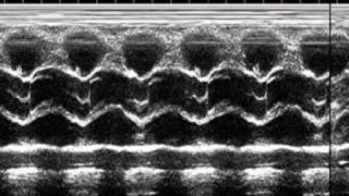 Bicuspid aortic valve [upl. by Kristine]