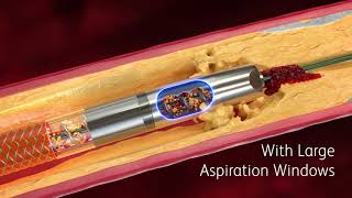 Rotarex™ Atherectomy System Now With Expanded Indications Mechanism of Action Video [upl. by Akemrehs478]