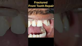 Fractured Front Tooth Repair [upl. by Eitsym]