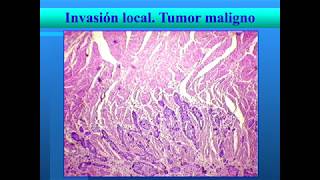 Neoplasias  Características de las neoplasias benignas y malignas [upl. by Jesher]