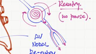 Taquicardia supraventricular vs ventricular [upl. by Aliemaj]