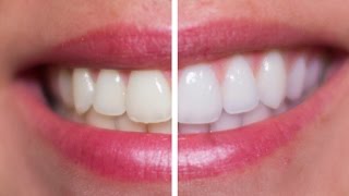 DIY Teeth Whitening Vs Professional [upl. by Ellegna]