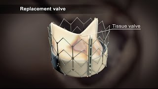 TAVI Transcatheter Aortic Valve Implantation [upl. by Trillbee]