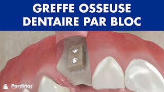 Greffe osseuse dentaire par bloc © [upl. by Radack]