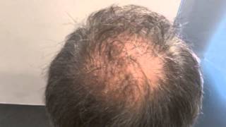 Scalp Micro pigmentation result prohairclinic [upl. by Carlynne644]