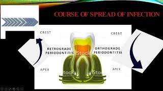 Endo Perio Lesions [upl. by Enelav]