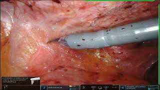 Robotic Adhesiolysis for recurrent Small Bowel Obstructions [upl. by Dannon789]