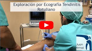 TENDINITIS CRÓNICA DEL ROTULIANO ECOGRAFÍA DE NEOVASCULARIZACIÓN [upl. by Annah]