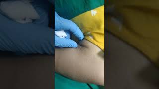 Mesotherapy Lipo Dissolve Injection Lipolysis treatment to Reduce Underarm Fat [upl. by Monsour564]