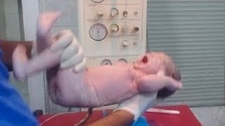 Cutest Newborn Down Syndrome baby after birth is so cute and super Flexible hospital cutevideo🥰🥰💞 [upl. by Nayra382]