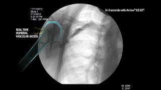 Arrow® EZIO® System  Proximal Humerus Infusion Fluoroscopy Adult Alert Patient [upl. by Nnylsor]