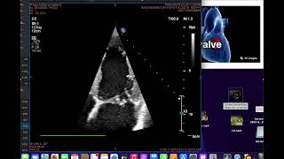 Flail anterior mitral leaflet [upl. by Sahc]