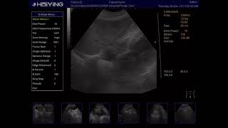 Ultrasoundtwisted abdominal aortatortuous aorta [upl. by Calhoun]