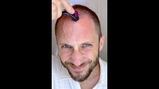 How I Use DermaRoller for Hair Growth and To Solve my Baldness and Hair Loss Tutorial 4k [upl. by Alyahsat]