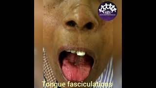 TONGUE FASCICULATIONS [upl. by Christoper117]