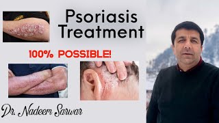 Psoriasis Treatment in Homeopathic by Dr M Nadeem Sarwar [upl. by Gawen]