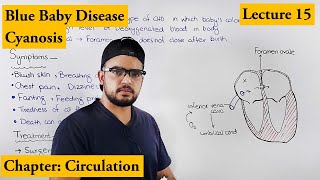 Cyanosis  Blue baby  Cardiovascular disorders  Chapter Circulation video 15 [upl. by Odnumyer451]