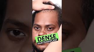 HighDensity Hair Transplant in Hyderabad  hairtransplant hairtransplanthyderabad shorts [upl. by Ariella766]