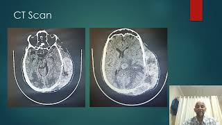 Metastatic Brain Tumors [upl. by Aciras]