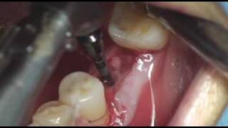 Dentium dental Implant Prosthetic36 IS 226 [upl. by Suryc]