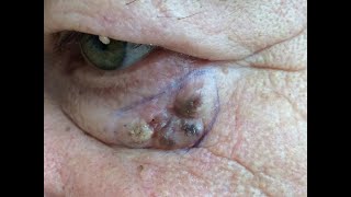 Basal Cell Carcinoma  Face Skin Cancer [upl. by Yrakaz]