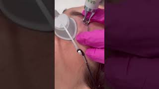 Tattoo eyebrow removal  Dr Medispa [upl. by Petula]